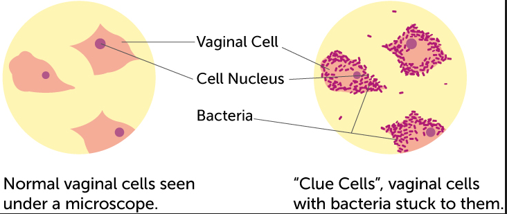 Bacterial vaginosis and infertility: Cause or association?